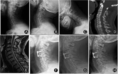 Anterior cervical discectomy and fusion to treat cervical instability with vertigo and dizziness: A single center, retrospective, observational study